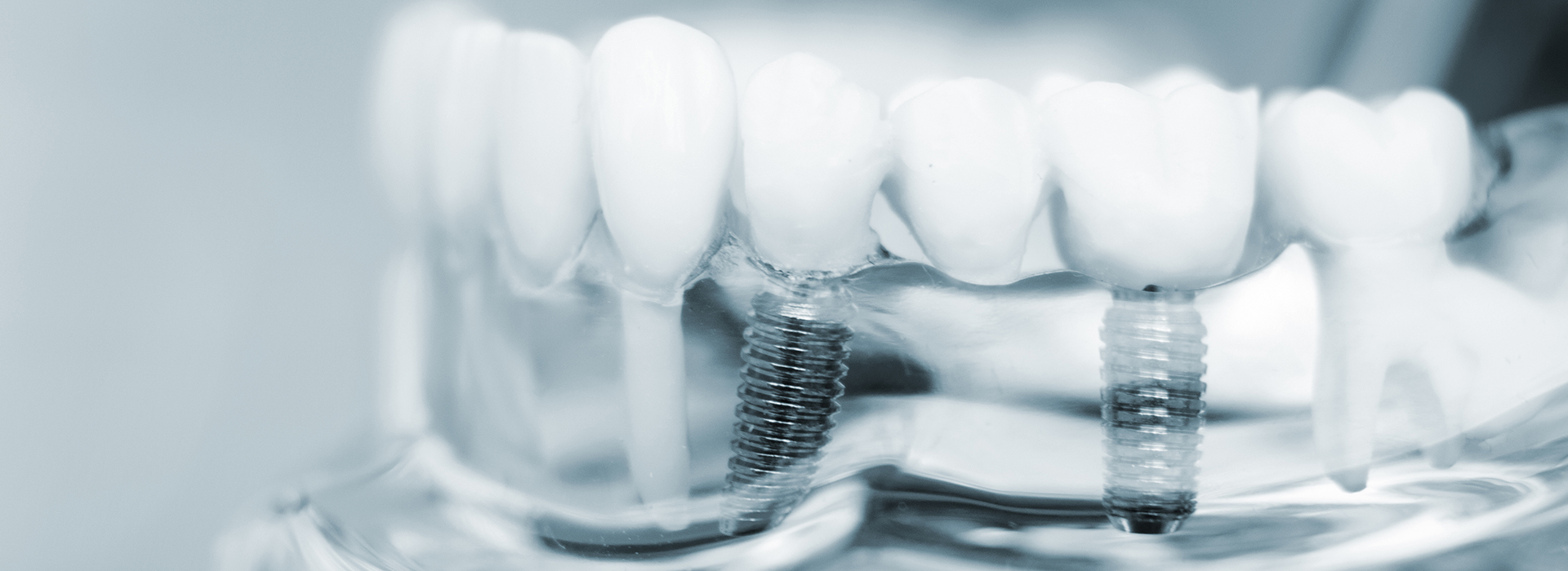 The image shows a close-up of dental implants with screws and abutments, displayed against a blurred background.