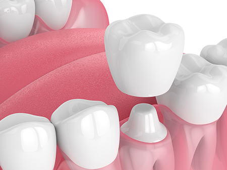 The image displays a collection of white teeth with pink gums, set against a plain background.